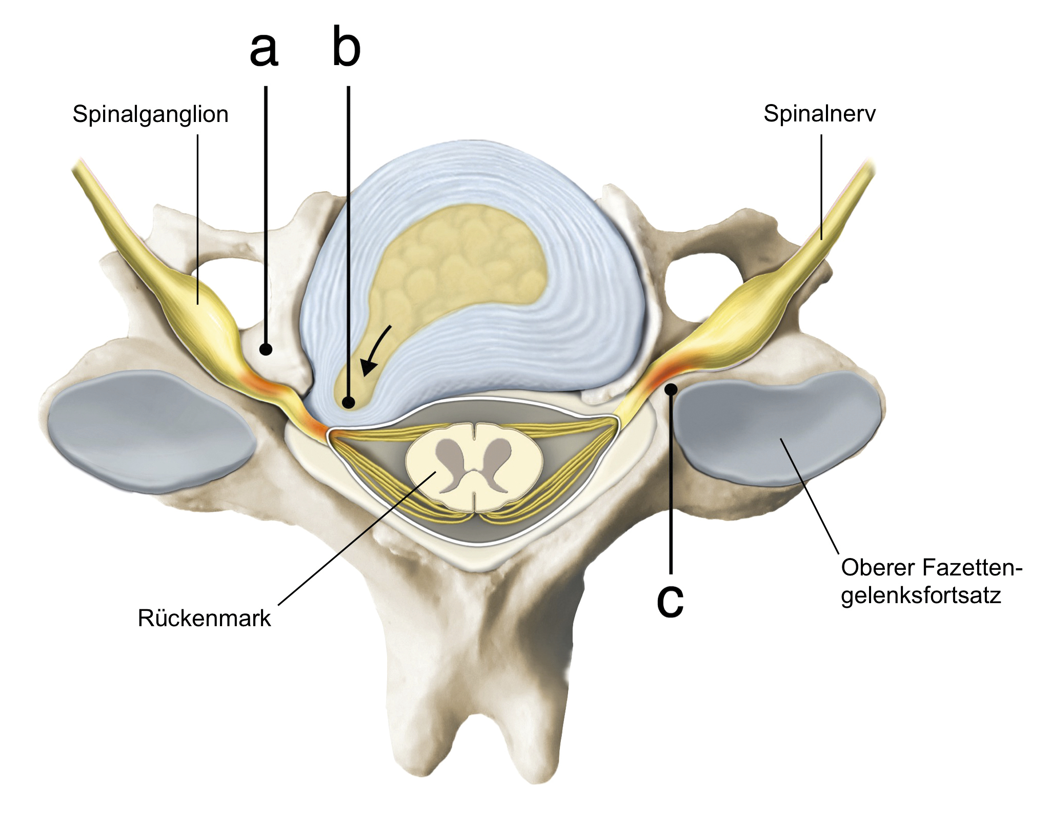 Neuroforamenstenose